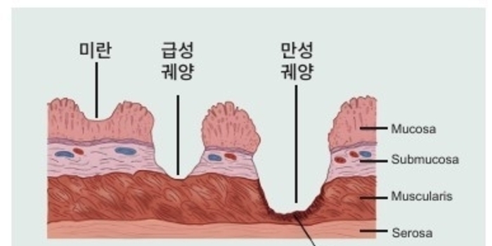 양돈장의 늘어난 가을철 불청객 : 위궤양 / 박건욱 원장